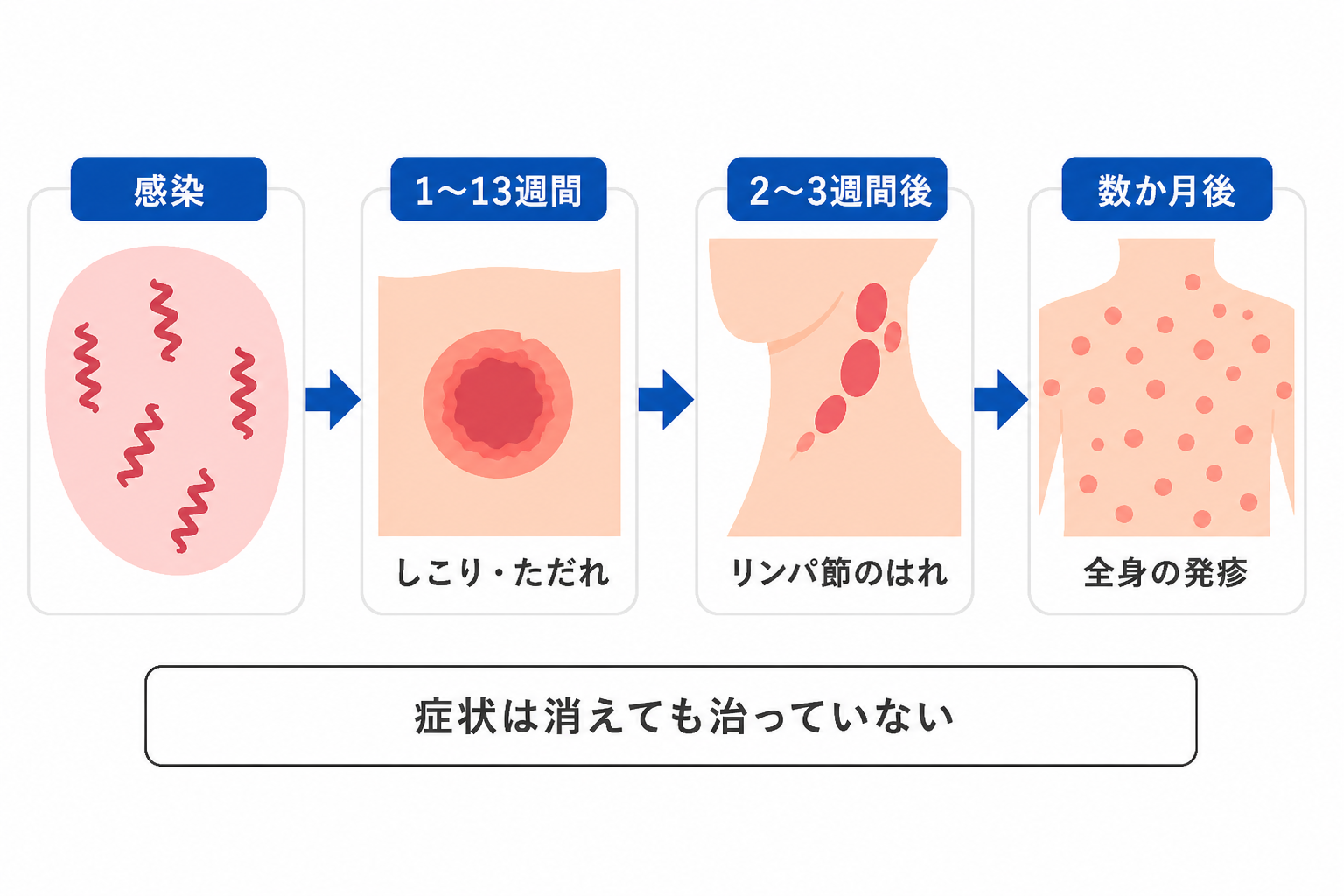 梅毒は感染から1〜13週間でしこり・ただれ、2〜3週間後にリンパ節のはれ、数か月後に全身の発疹。症状は消えても治っていない